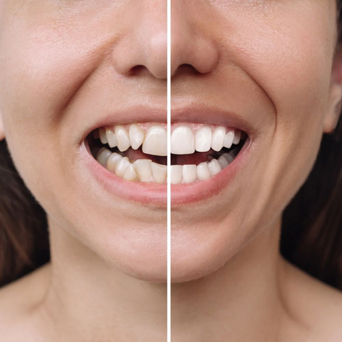 Before and After Teeth Whitening Results