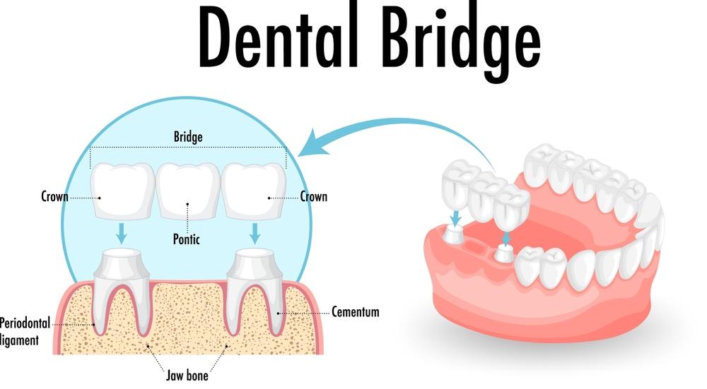 Graphic Photo of Dental Bridges in Kokomo Family Dentistry