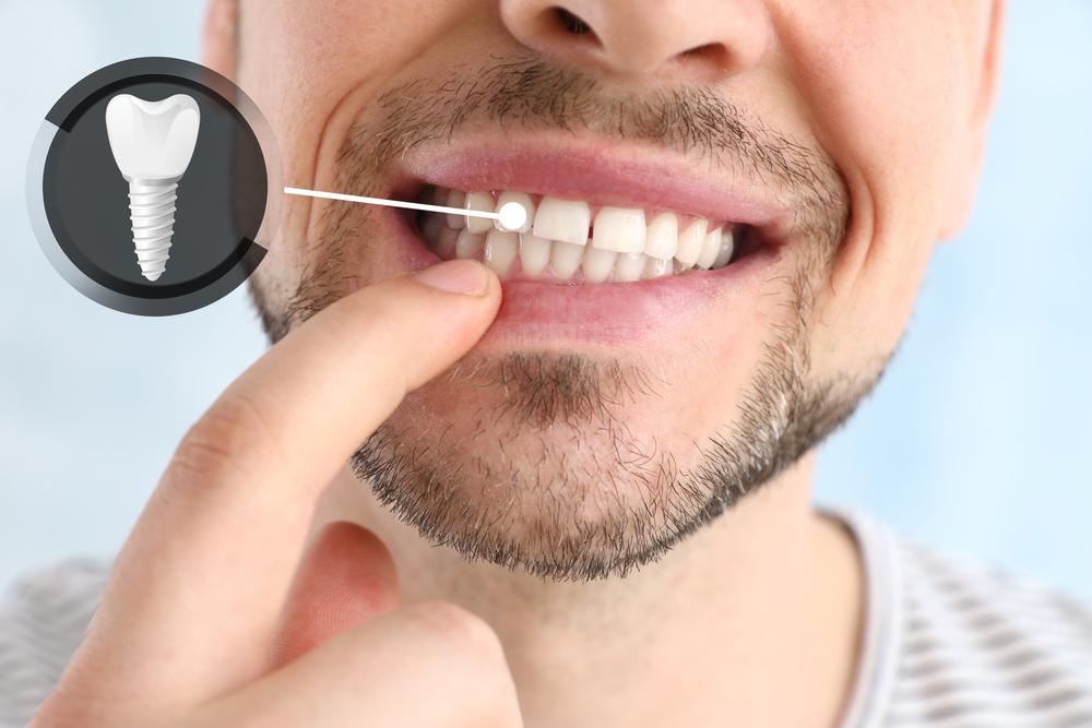 Dental Implants Dental Services in Kokomo Family Dentistry