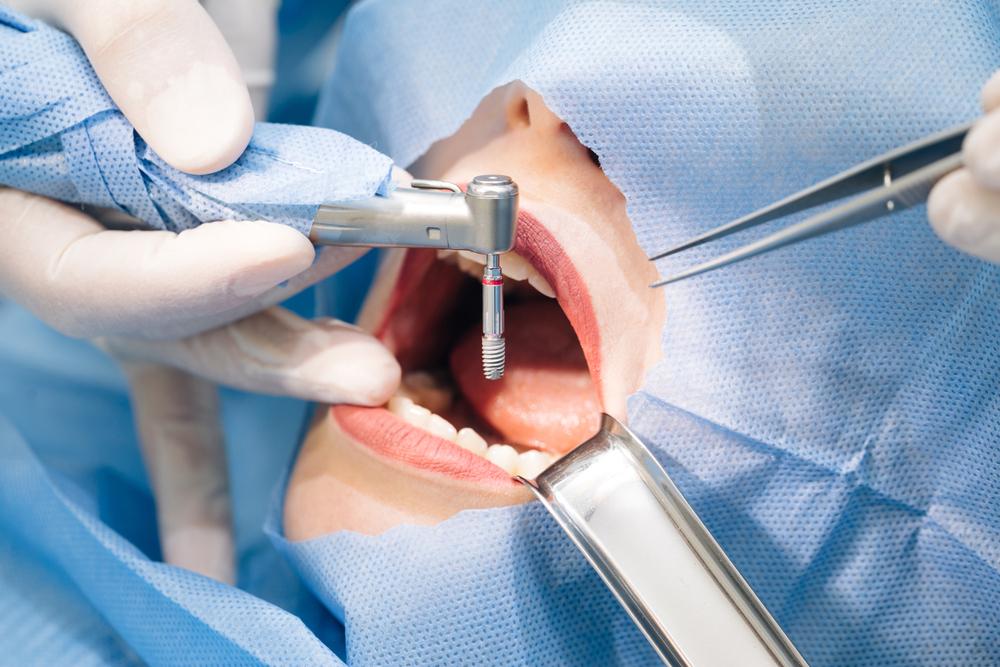 Dental Implants Procedure in Kokomo Family Dentistry
