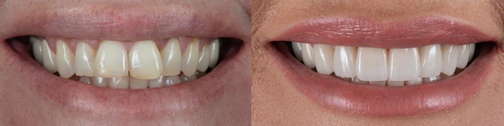 Before and After Photos of Porcelain Veneers Treatment at Kokomo Family Dentistry