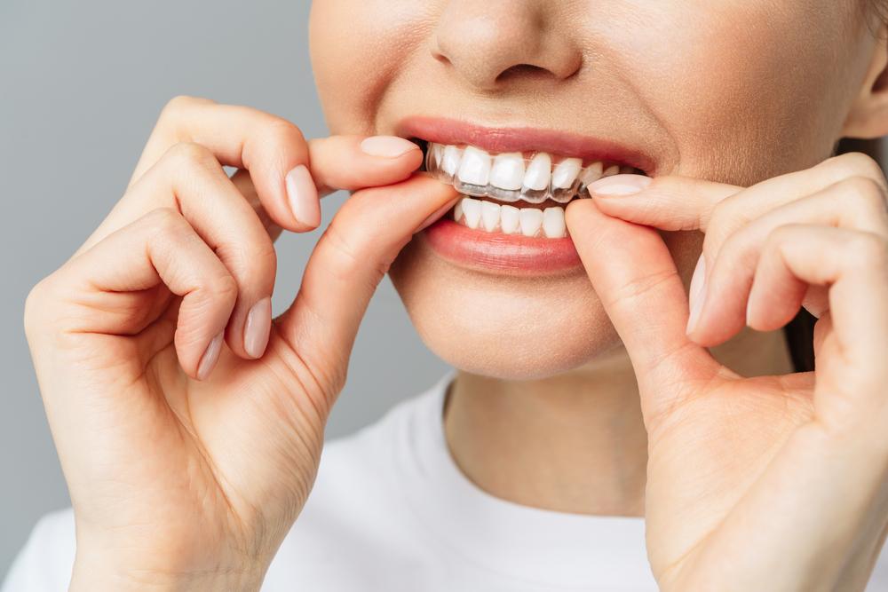 Teeth Whitening Trays in Kokomo Family Dentistry