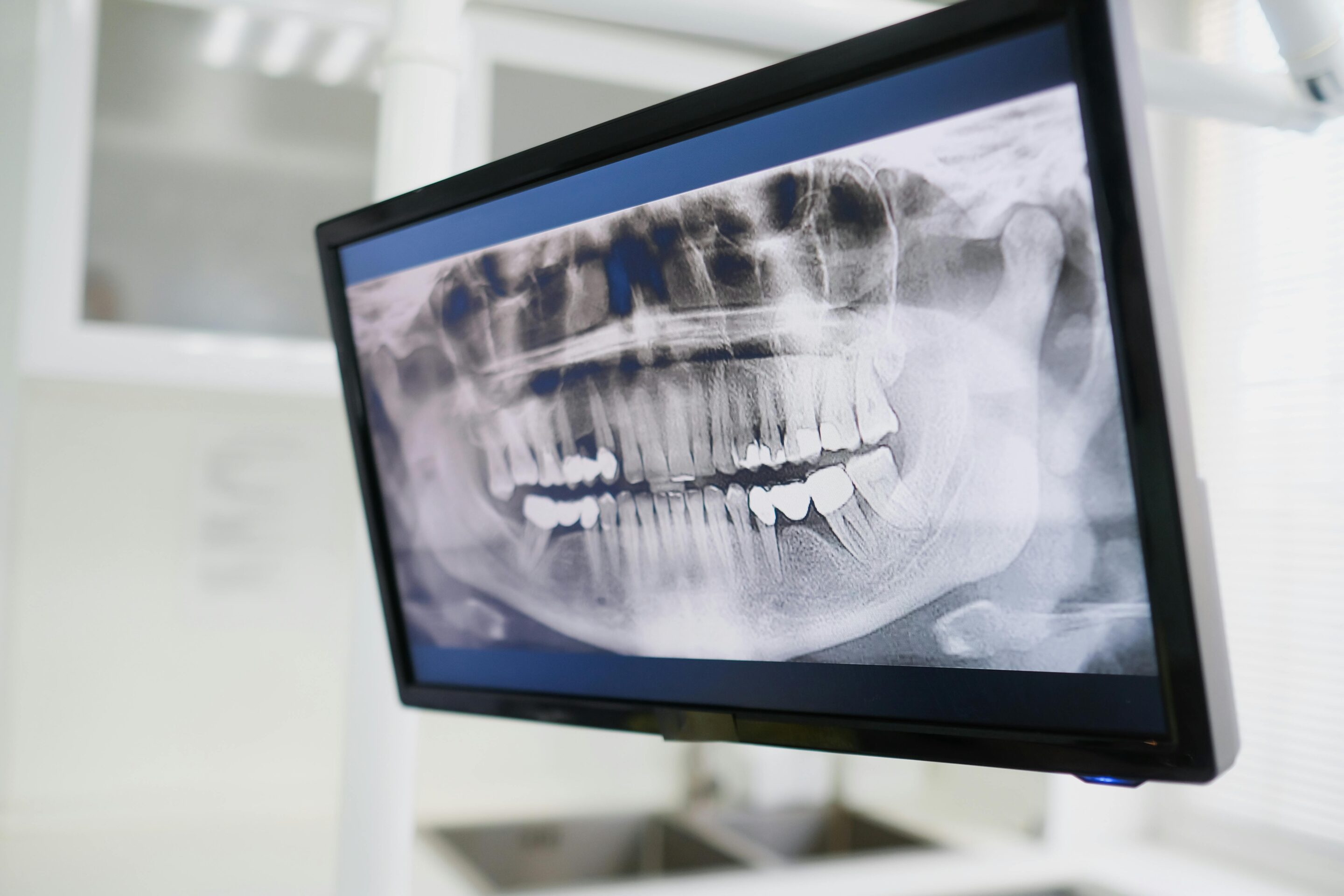A flat screen monitor showing a digital x-ray at Kokomo Family Dentistry